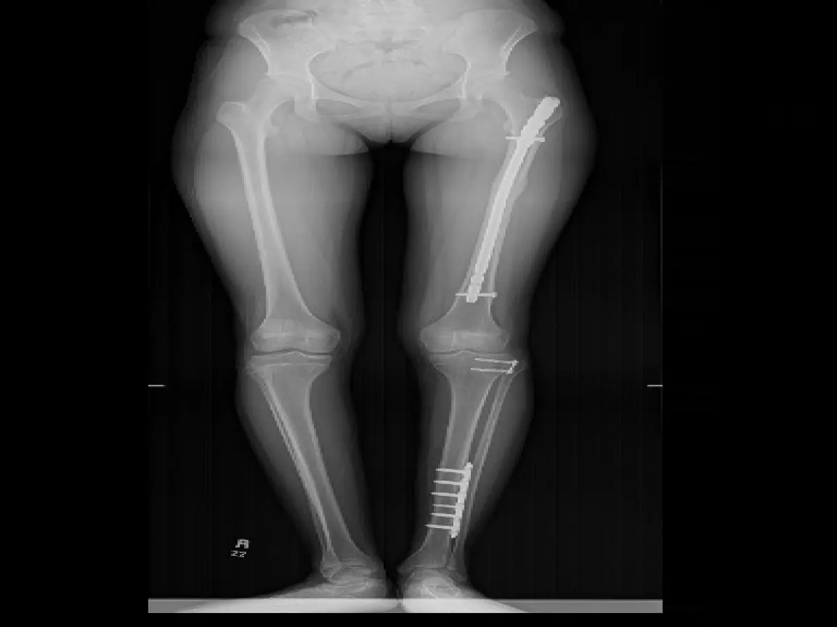عمليات تعديل دوران عظم الفخذ للداخل المفرط