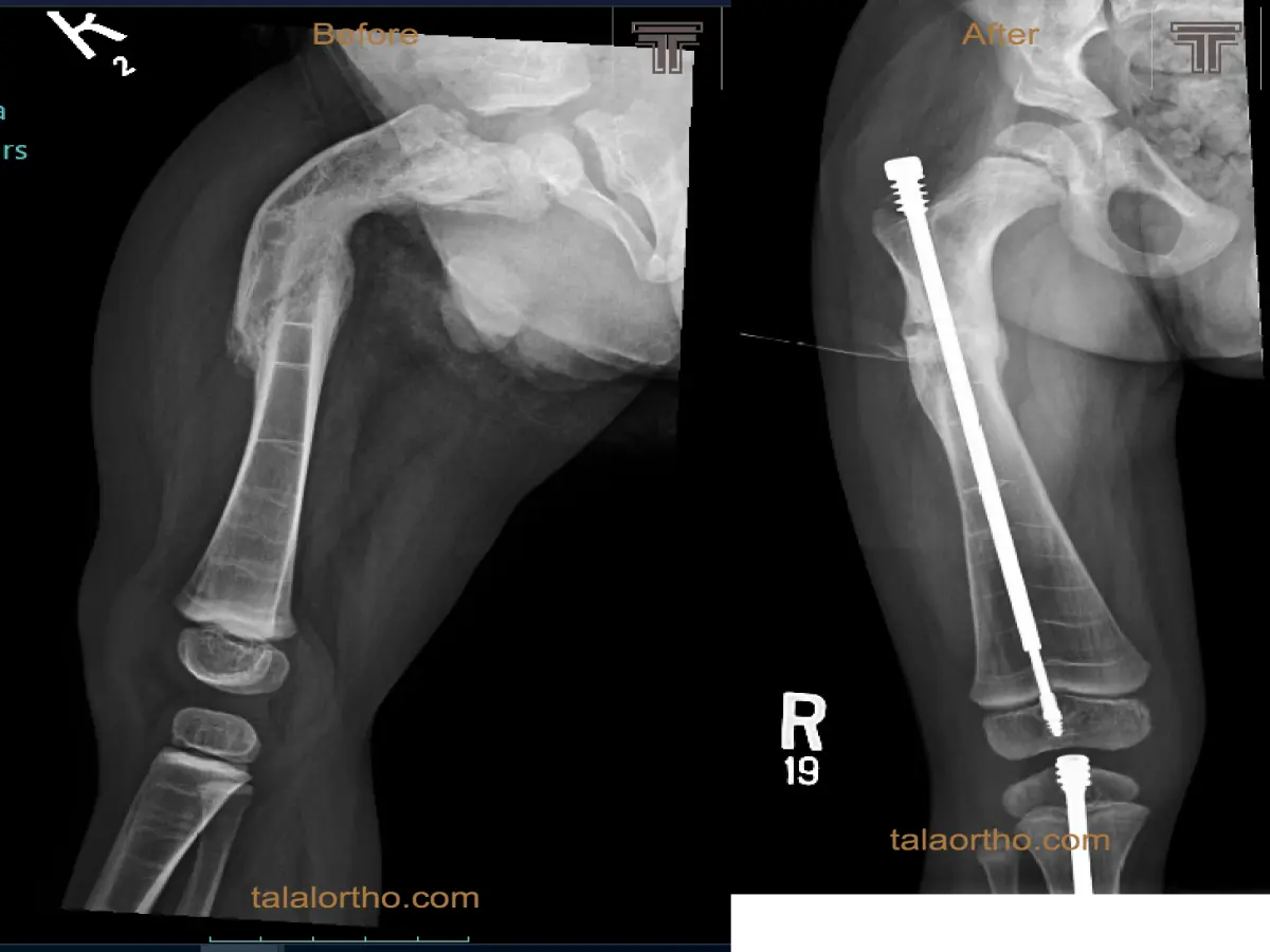 علاج كسور وتشوهات مرضى العظم الزجاجي