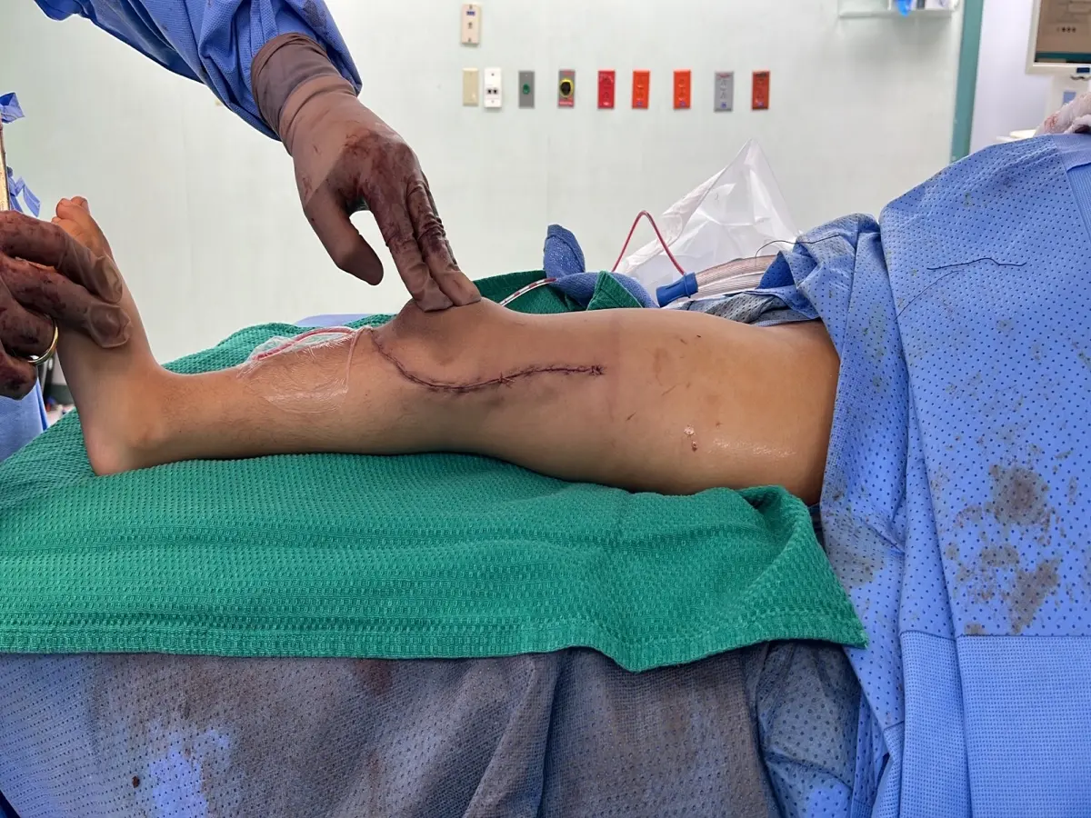 علاج خلع الصابونة الخلقي