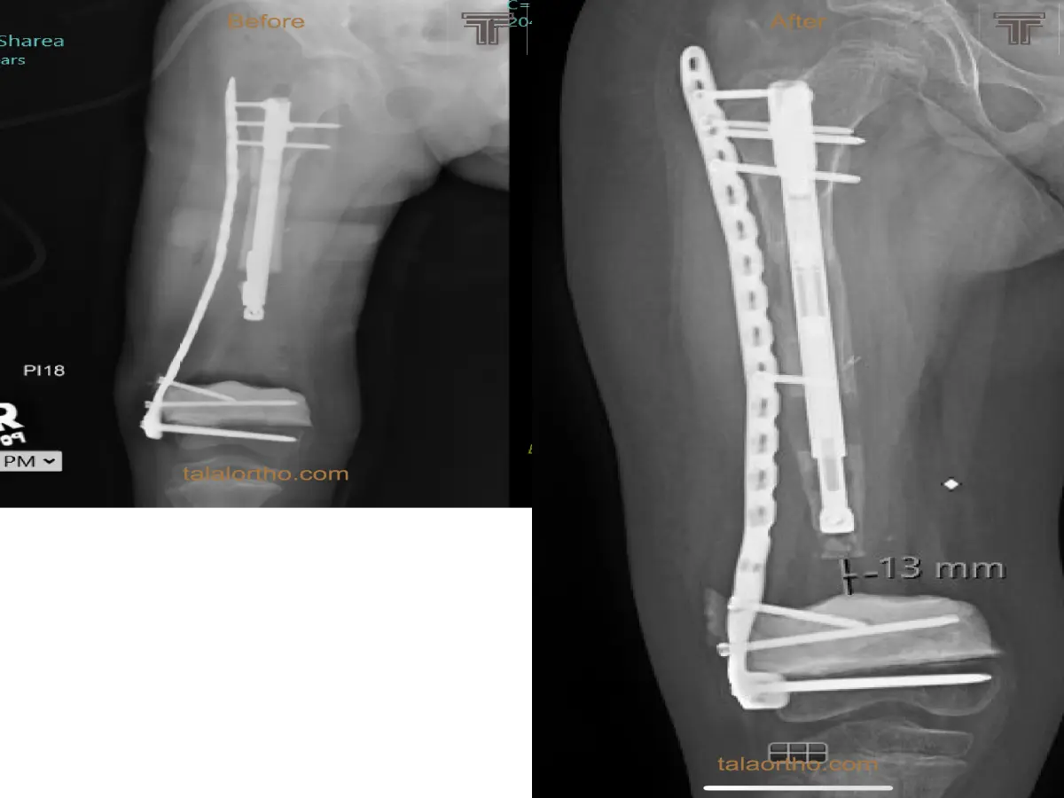 علاج فقد العظم بواسطة نقل العظم التدريجي
