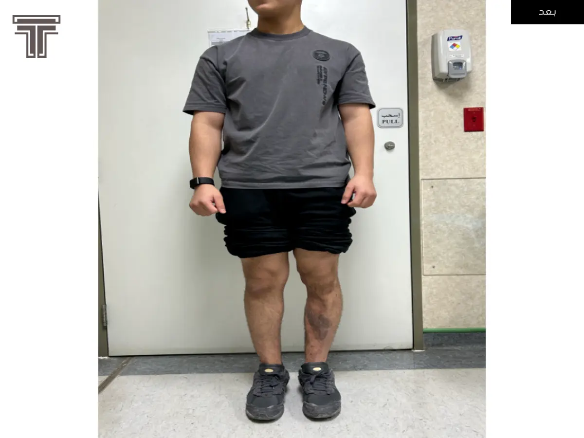 تعديل تشوه ناتج عن كسر في منطقة النمو