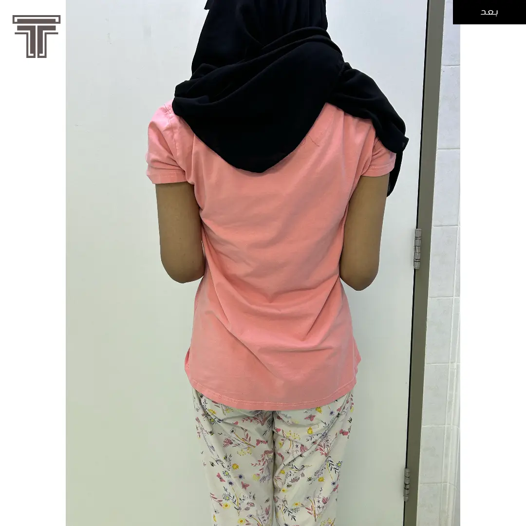 تطويل عظمة الساعد بسبب قصر ناتج عن التهاب مبكر اثناء الصغر في مركز النمو