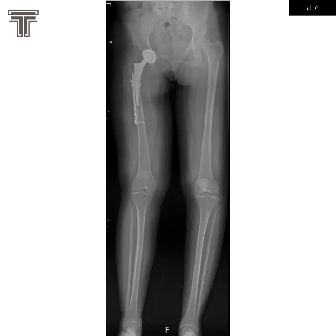 عملية تطويل للفخذ الأيمن لقصر ناتج عن عملية استبدال مفصل ورك