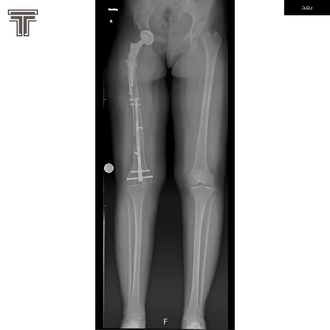 عملية تطويل للفخذ الأيمن لقصر ناتج عن عملية استبدال مفصل ورك