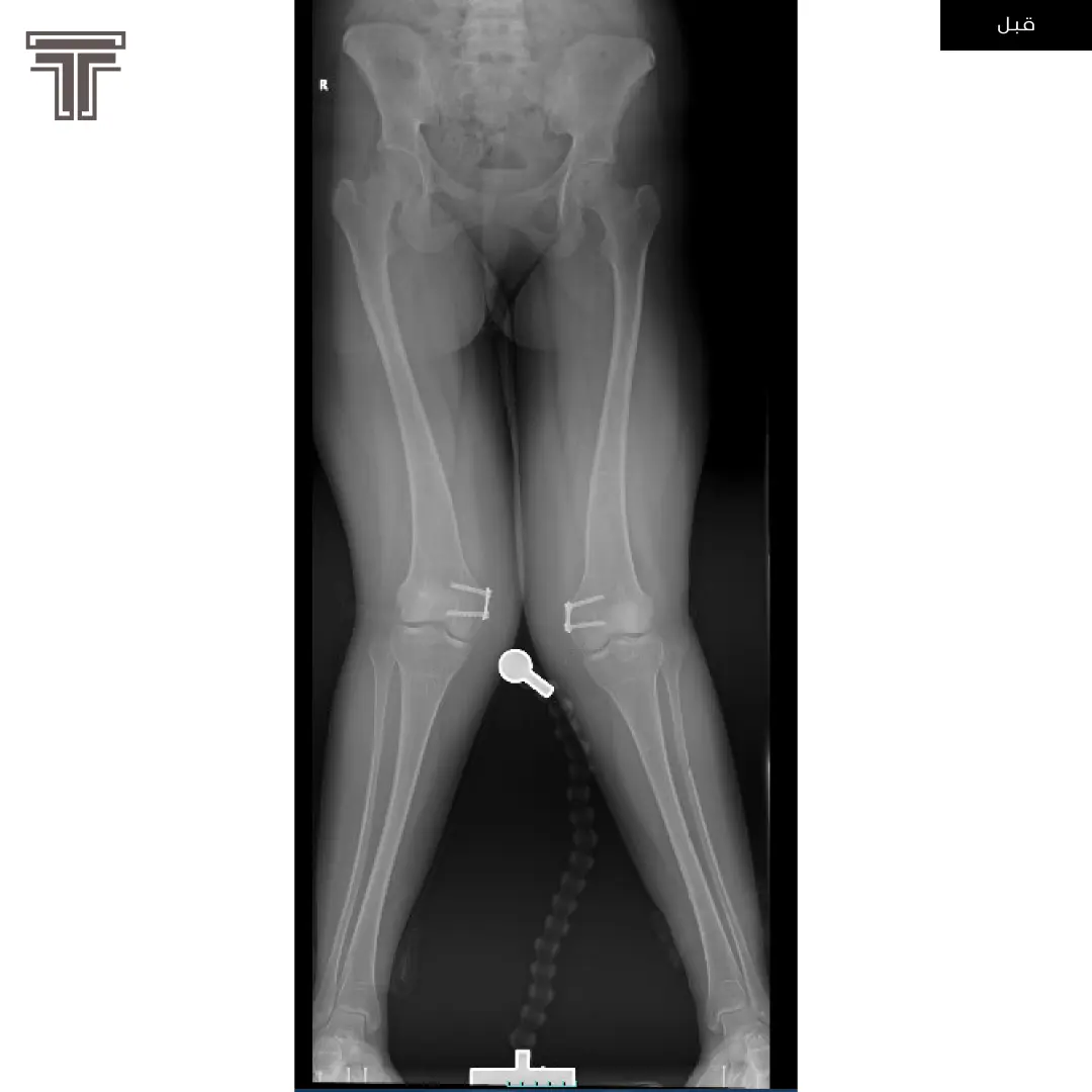 تقوس للخارج ناتج عن كساح في العظم
