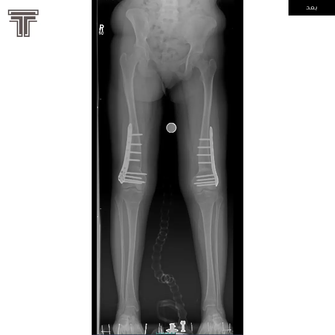 تقوس للخارج ناتج عن كساح في العظم