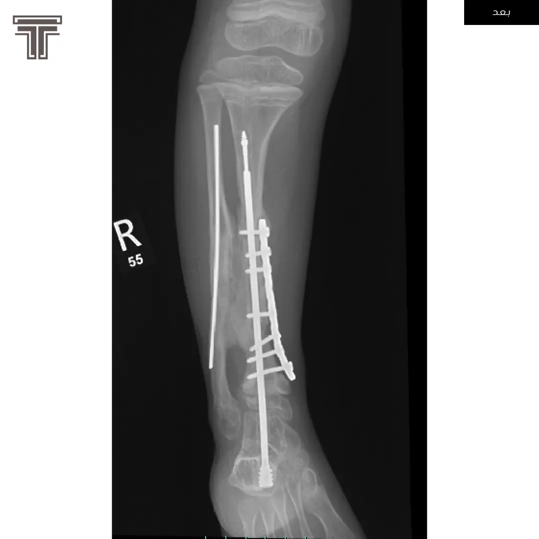 كسر كاذب في عظمة الساق