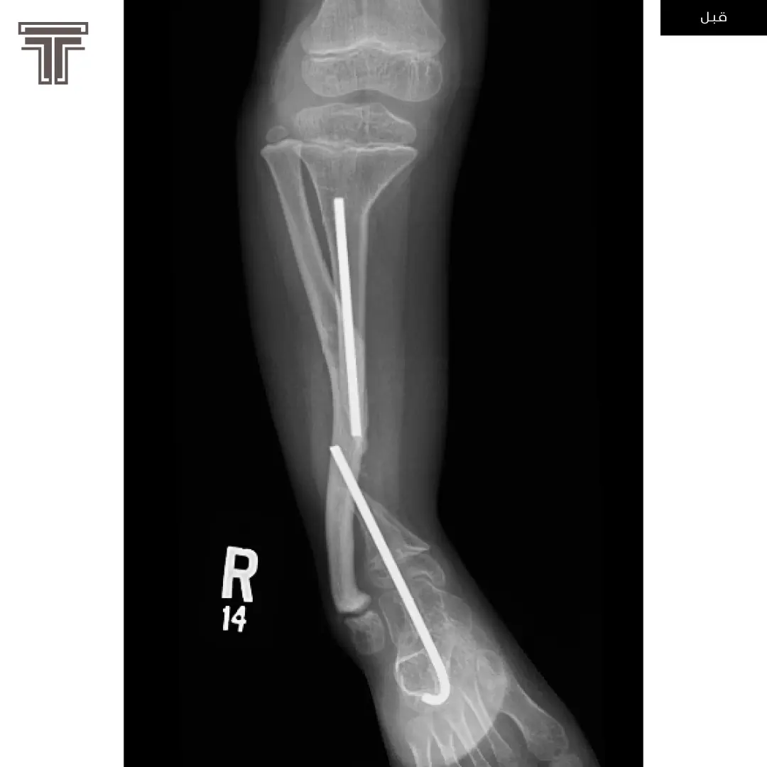 كسر كاذب في عظمة الساق
