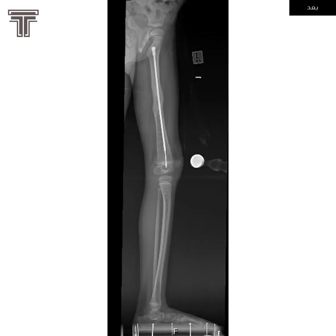 اصلاح تشوه في الفخذ بعد كسور في العظم متكرره ناتجة عن فشل في الكبد