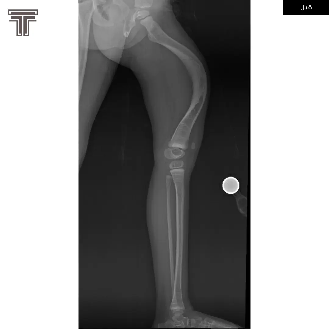 اصلاح تشوه في الفخذ بعد كسور في العظم متكرره ناتجة عن فشل في الكبد
